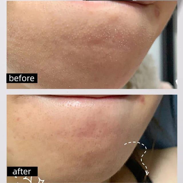 Niacinamide Skin peeling Serum