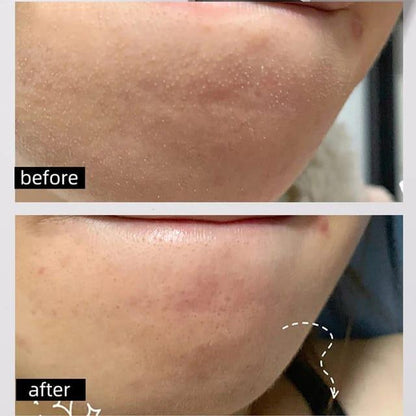 Niacinamide Skin peeling Serum
